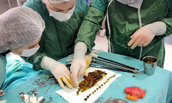 Karın ağrısıyla gitti, safra kesesinden binlerce taş çıktı