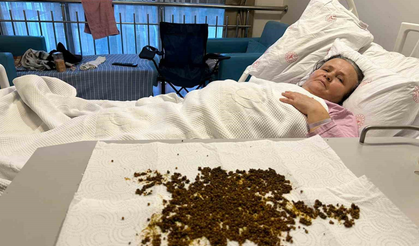 Hastadan çıkan taşlar doktorları şaşkına uğrattı