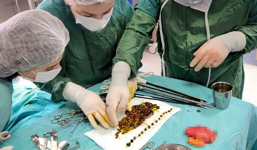 Karın ağrısıyla gitti, safra kesesinden binlerce taş çıktı